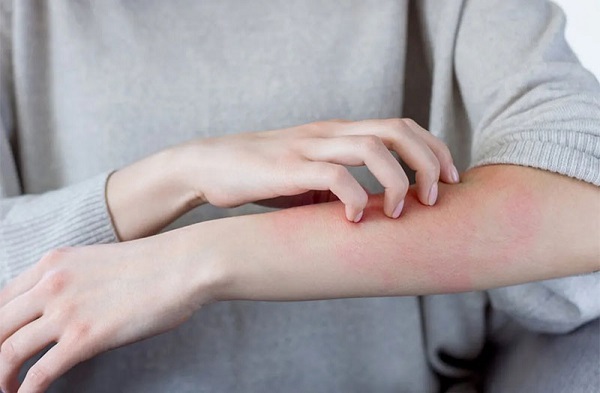 Da bị ngứa khi trời lạnh