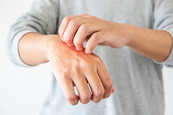 Da bị ngứa khi trời lạnh