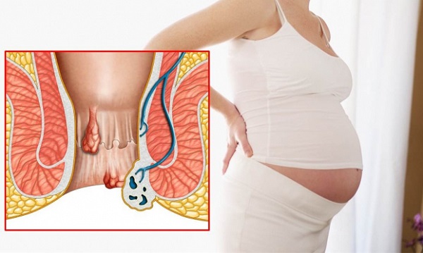 nguyên nhân gây ra bệnh trĩ trong quá trình mang thai