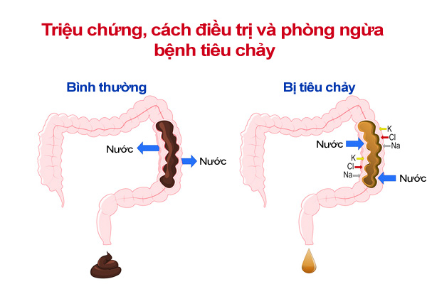 Bệnh tiêu chảy là gì?
