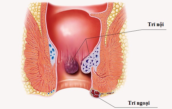 Bệnh trĩ