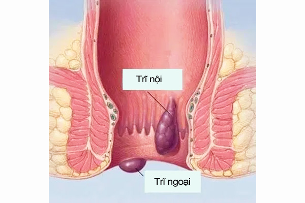 Bệnh trĩ là gì?