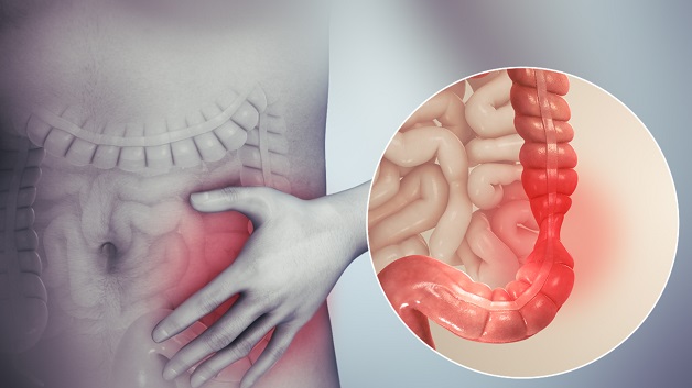 Bệnh viêm ruột