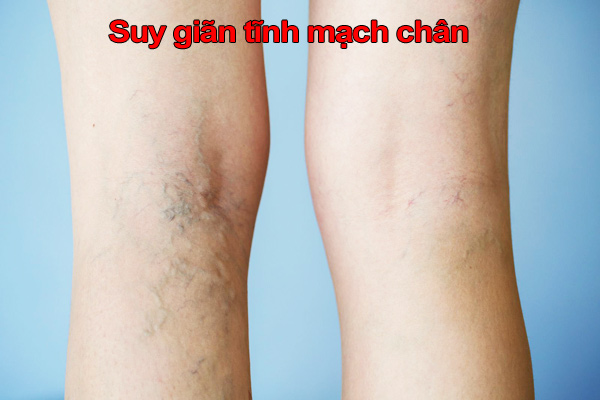 Bệnh nhân suy giãn tĩnh mạch chân có chạy bộ được không?