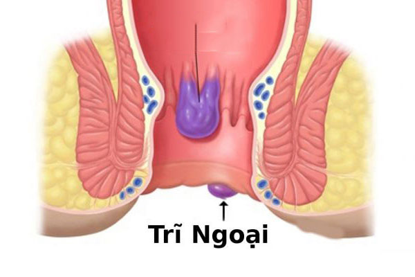 Cách chữa bệnh trĩ ngoại tại nhà hiệu quả
