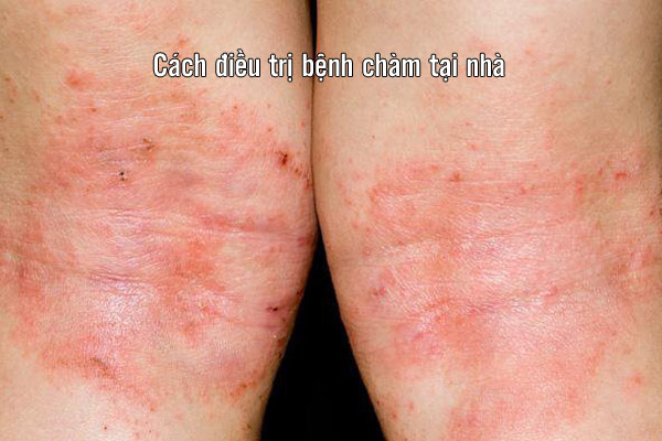 cách điều trị bệnh chàm tại nhà