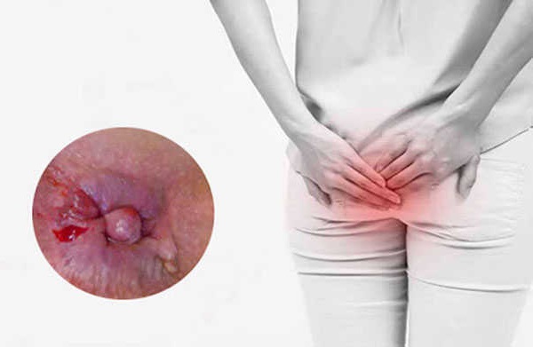 Làm sao để búi trĩ thụt vào?