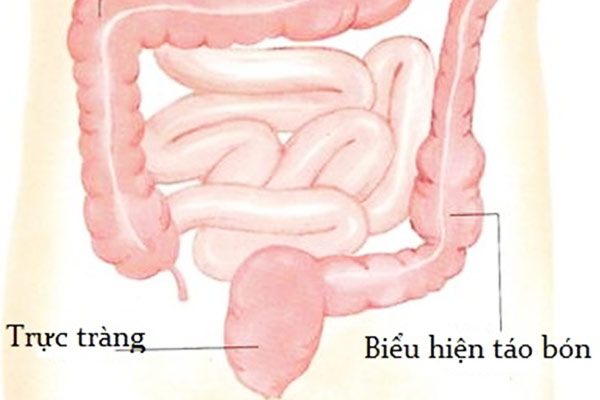 Mối nguy hiểm của Hội chứng ruột kích thích thể táo bón (IBS-C)