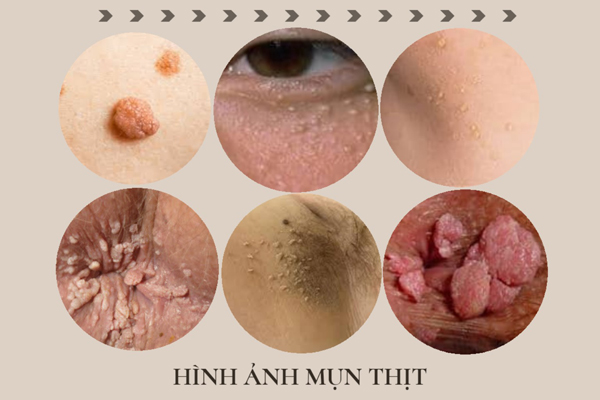 Mụn thịt là gì?