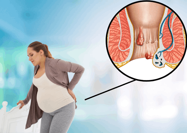 Bà bầu bị trĩ phải làm sao?