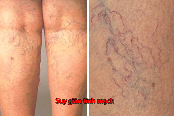Suy giãn tĩnh mạch là gì?