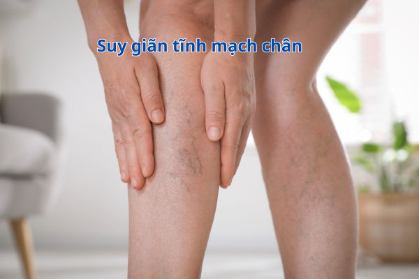 Suy giãn tĩnh mạch chân