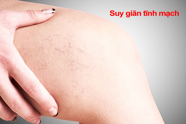 Bệnh suy giãn tỉnh mạch