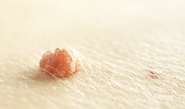 Cách trị thịt dư ở cổ