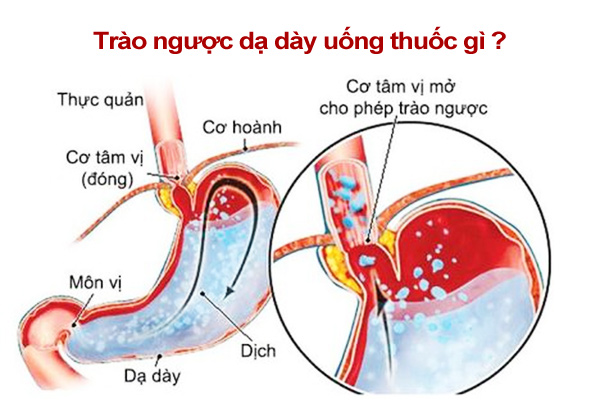 Trào ngược dạ dày nên uống thuốc gì?