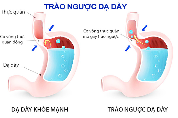 bệnh trào ngược dạ dày