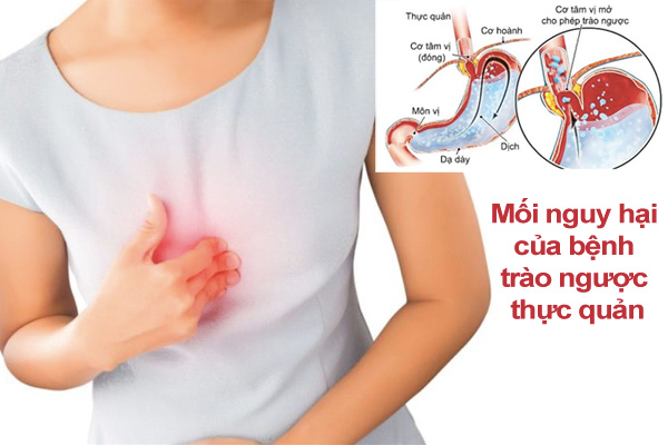 Biến chứng trào ngược dạ dày thực quản
