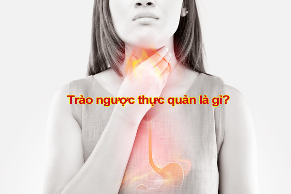 Trào ngược thực quản là gì?