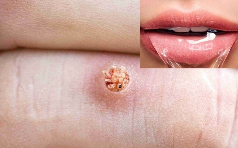 Trị mụn cóc bằng nước miếng được không?