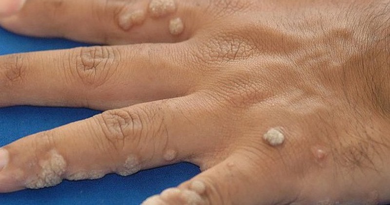 Trị mụn cóc bằng nước bọt như thế nào?
