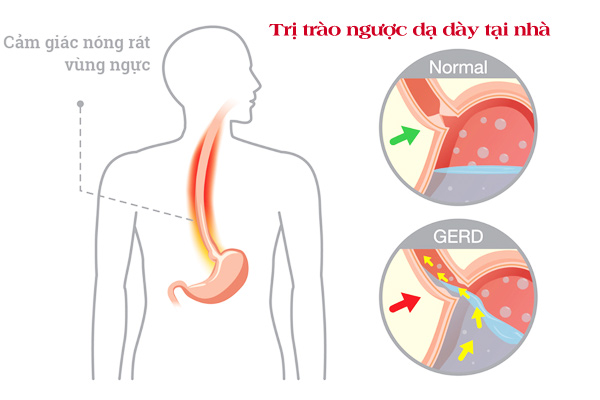 Cách trị trào ngược dạ dày tại nhà