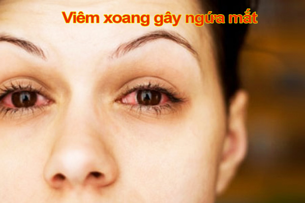 viêm xoang gây ngứa mắt